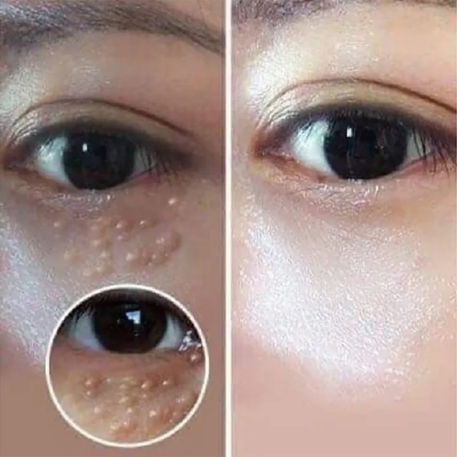 Kem hỗ trợ điều trị mụn thịt vùng mắt Tsubuporon Eye Essence 1.8ml