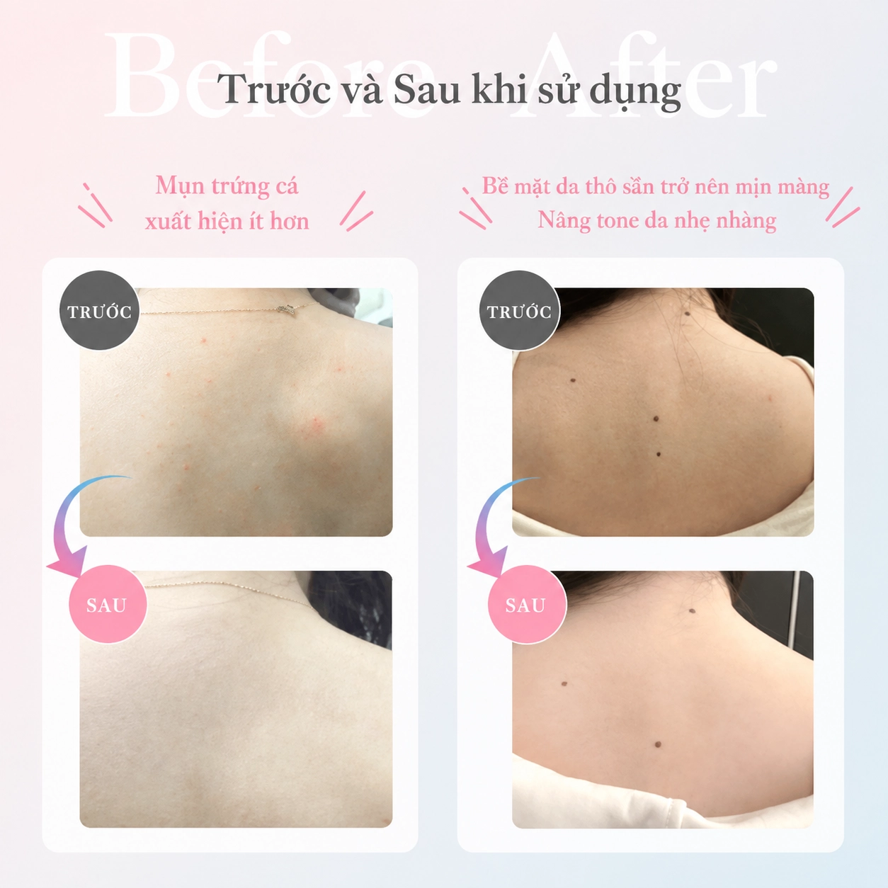 Gel làm sáng da, giảm mụn lưng Carico Silky Back Whitening & Acne Care Gel 100g