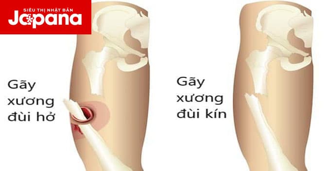 Đừng chủ quan tình trạng gãy xương đùi