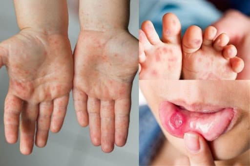 Dịch tay chân miệng đang cao điểm: Bố mẹ cần làm gì để bảo vệ con?