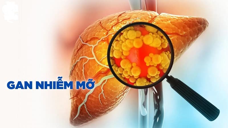 Thuốc điều trị gan nhiễm mỡ độ 2 tốt nhất hiện nay