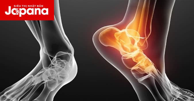 3 sai lầm thường mắc phải khi xử lý chấn thương trật khớp bàn chân