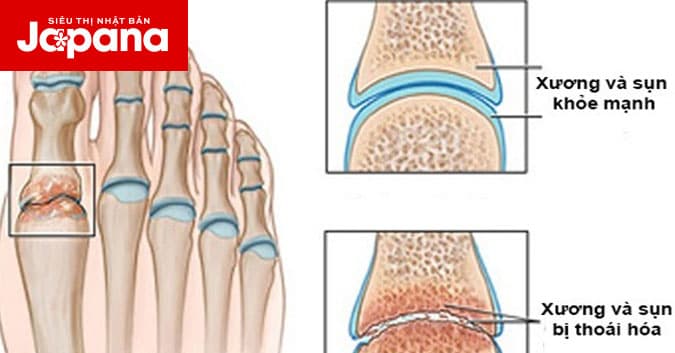 Thoái hoá khớp bàn ngón chân báo hiệu nguy cơ tàn phế