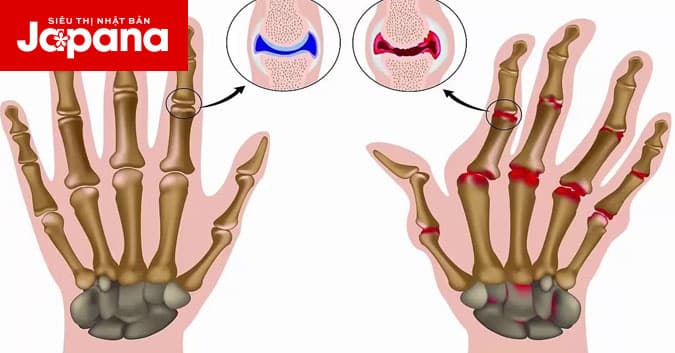 4 dấu hiệu cảnh báo viêm khớp sớm và cách phòng ngừa