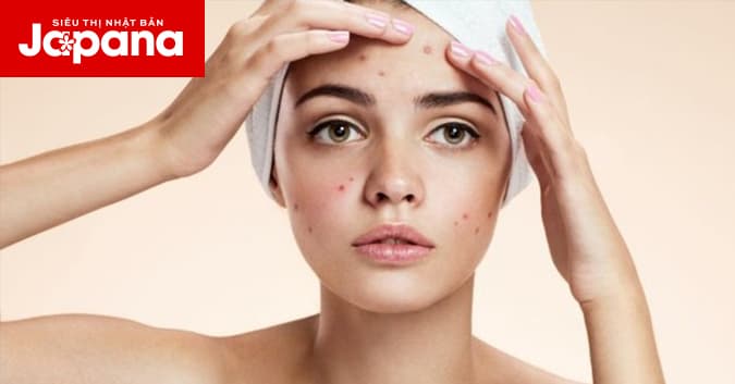 6 cách trị mụn đầu đen được tiết lộ từ các chuyên gia da liễu hàng đầu