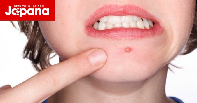 Tổng hợp các loại mụn thường gặp
