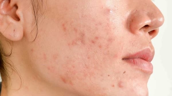 Bị sẹo thâm do mụn phải làm sao? Tiết lộ 3 cách điều trị cực kỳ đơn giản
