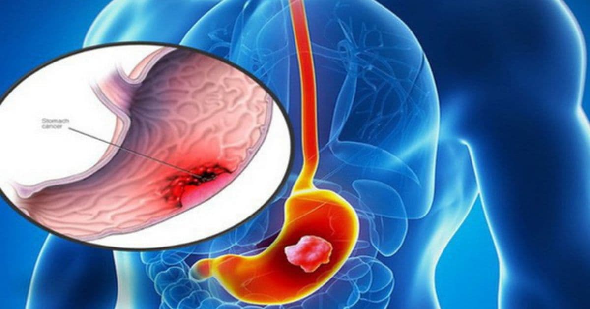 TOP 5 sản phẩm viên uống chữa viêm loét dạ dày tốt nhất hiện nay