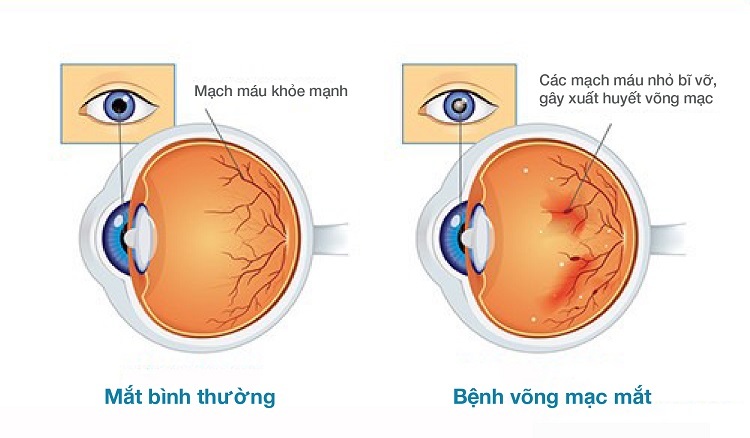 Những chất dinh dưỡng cho đôi mắt sáng khỏe