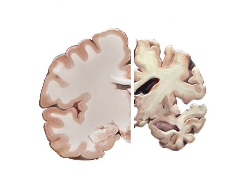 Alzheimer – Căn bệnh “mất trí nhớ” thường gặp ở người cao tuổi