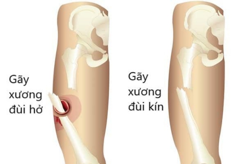 Gãy xương đùi khó điều trị, phục hồi và dễ để lại di chứng nguy hiểm