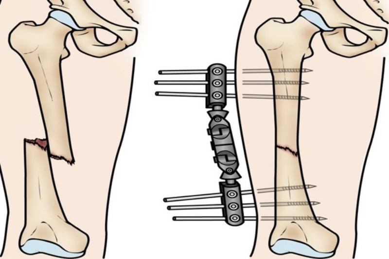 Cố định xương đùi bị gãy bằng khung cố định ở bên ngoài