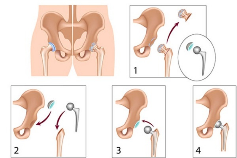 Điều trị phẫu thuật kết hợp xương