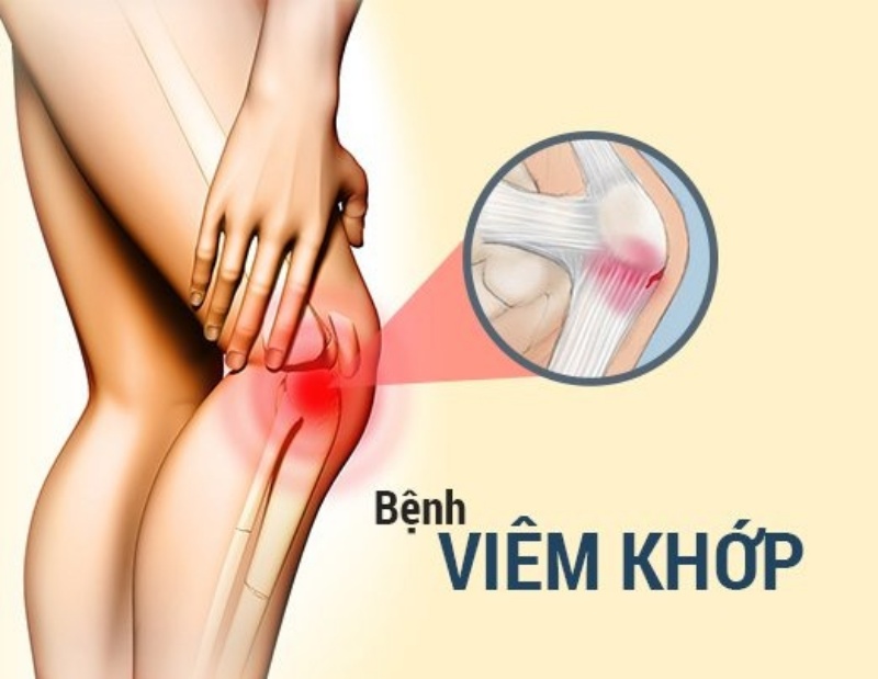 Phát hiện viêm khớp sớm bằng xạ hình xương