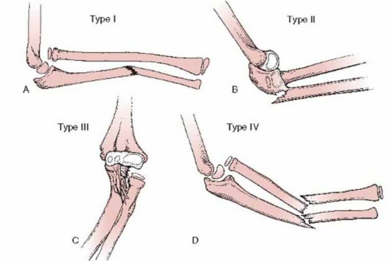 Phân loại các trường hợp gãy Monteggia