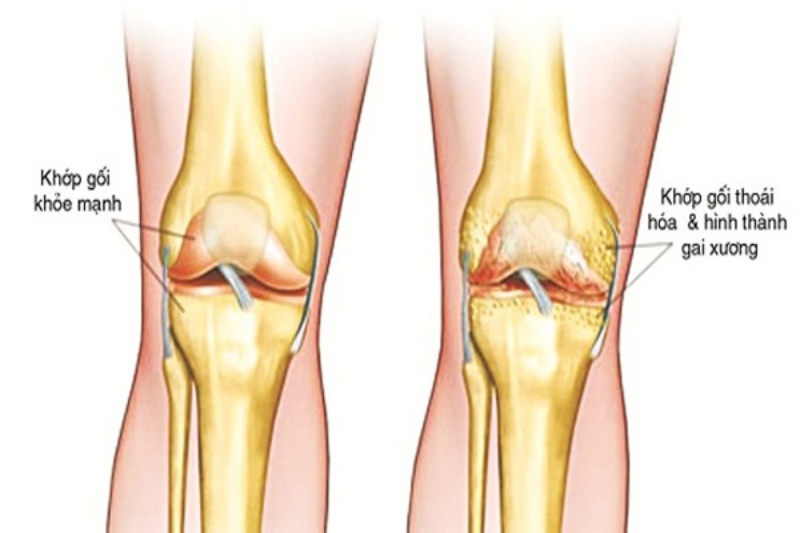 Thoái hóa khớp gối gây ra đau đớn, sưng viêm và gây khó khăn cho việc đi lại và hoạt động của người bệnh