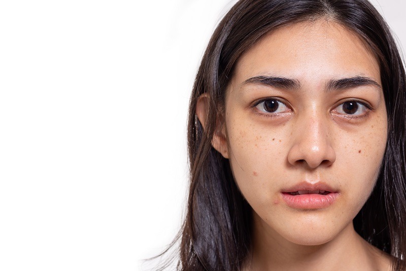 Stress khiến da sạm màu đi