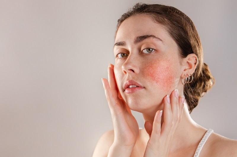 Stress làm tăng nguy cơ mắc các bệnh viêm da 