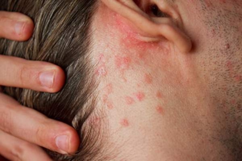 Dưỡng tóc bằng nha đam giúp chữa trị bệnh eczema