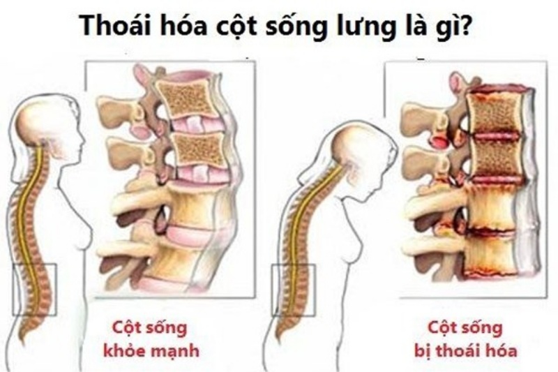 Phân biệt cột sống của người bình thường và người bị thoái hóa