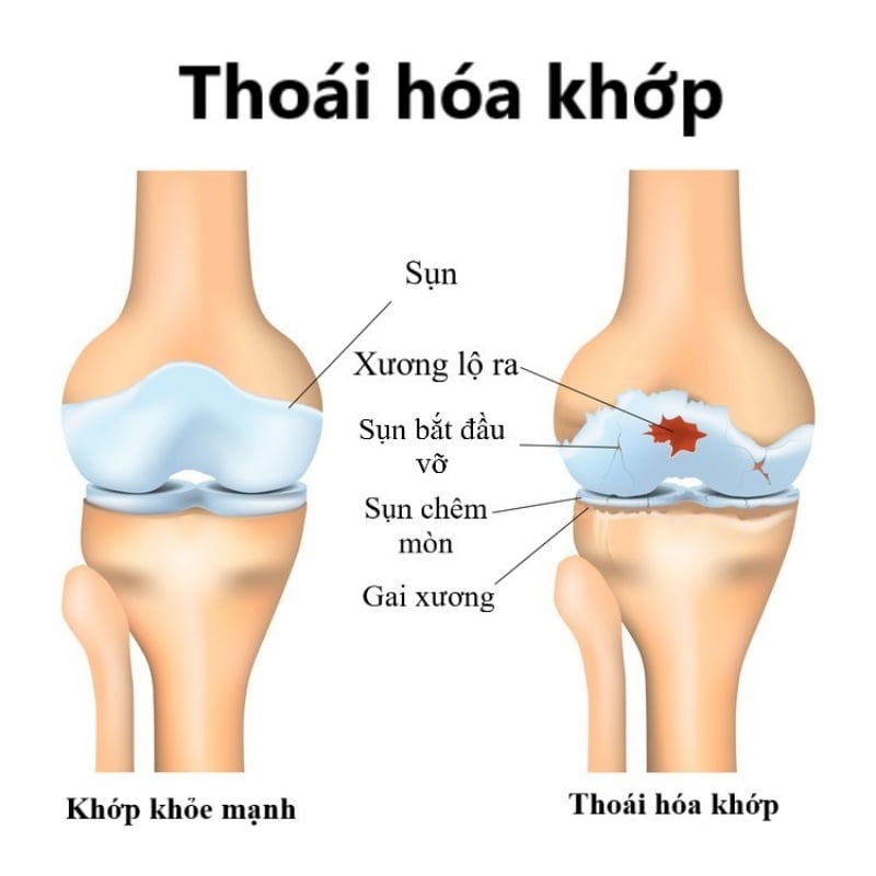 Những yếu tố nào làm tăng nguy cơ mắc thoái hóa khớp?