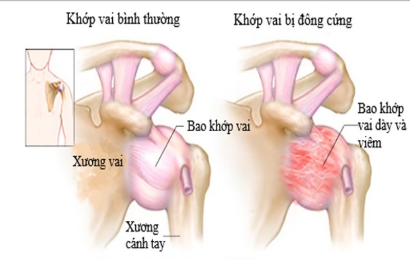 Viêm khớp vai thể đông đặc là chứng bệnh gì?