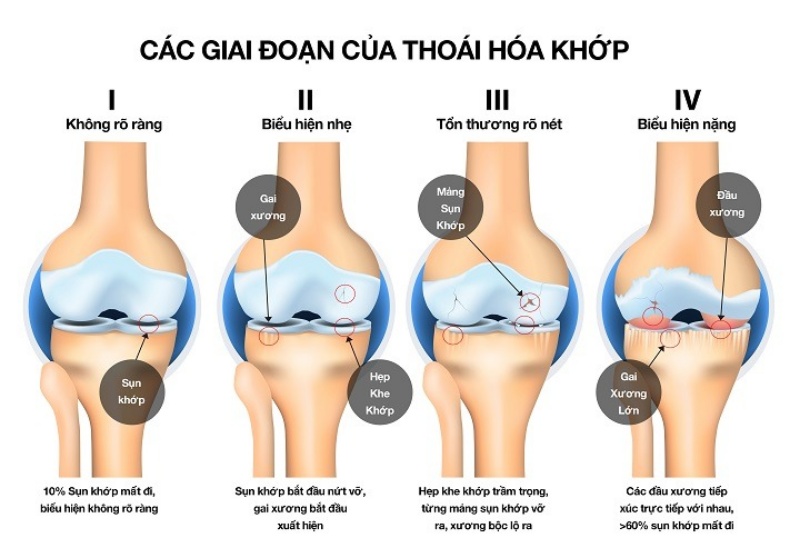 Thoái hóa khớp gối là gì?