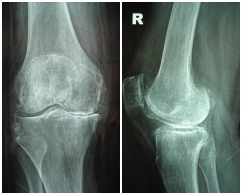 Hình ảnh của khớp gối trên phim X-quang: Khe khớp hẹp nhiều, gai xương có kích thước lớn, đặc xương dưới sụn, đầu xương biến dạng rõ.