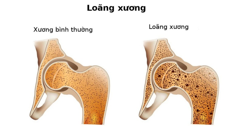 Loãng xương thường phát triển thầm lặng