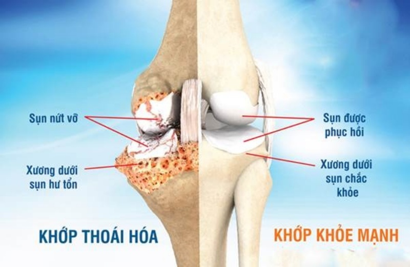 Chăm sóc sụn và xương dưới sụn, tăng độ bền cho khớp