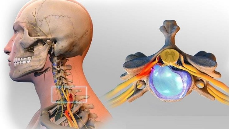 Vị trí thoát vị đĩa đệm đốt sống cổ thường gặp