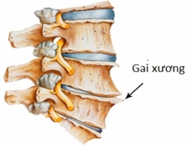 Gai cột sống là gì?