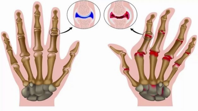 Biến chứng của viêm khớp dạng thấp