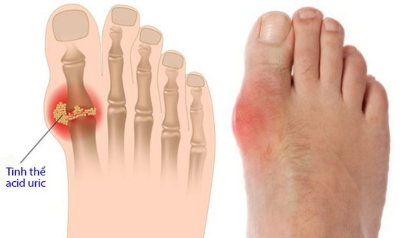 Cách làm nước đu đủ và trà xanh để giảm bệnh gout