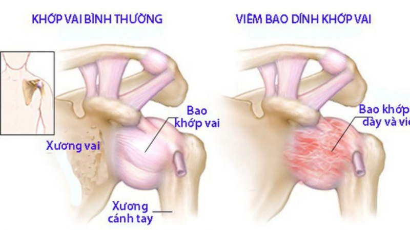 Viêm dính bao khớp vai hay còn gọi là viêm quanh khớp vai thể đông cứng