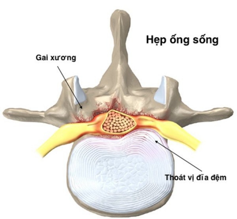 Hẹp ống sống là bệnh thường xảy ra ở người trung niên và lớn tuổi