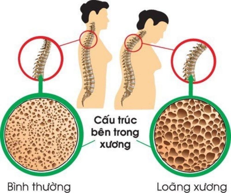 Tác hại của loãng xương