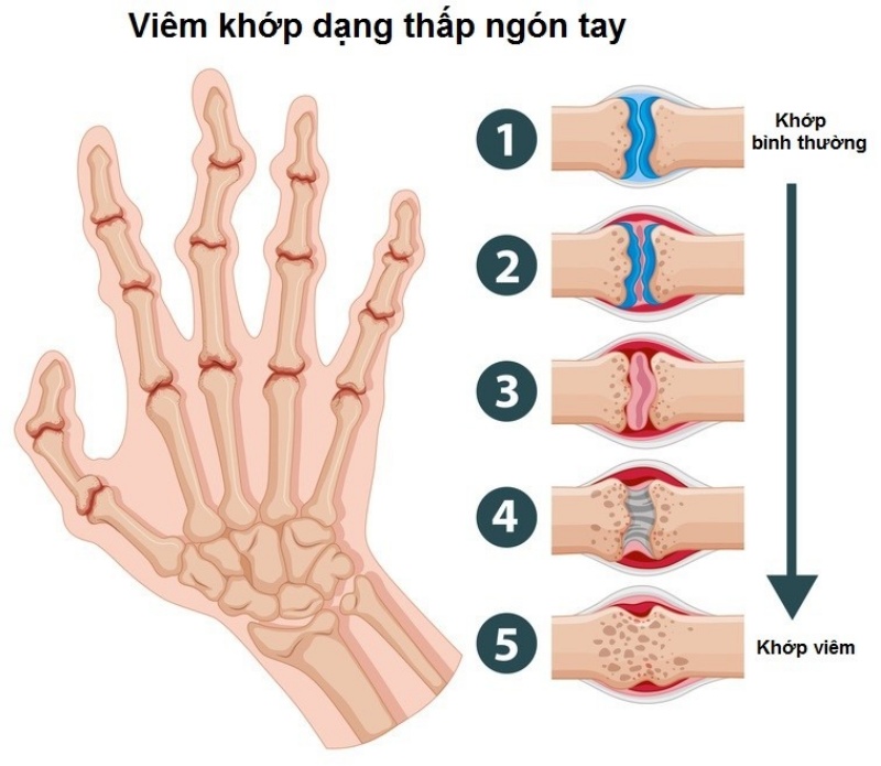 Viêm khớp dạng thấp