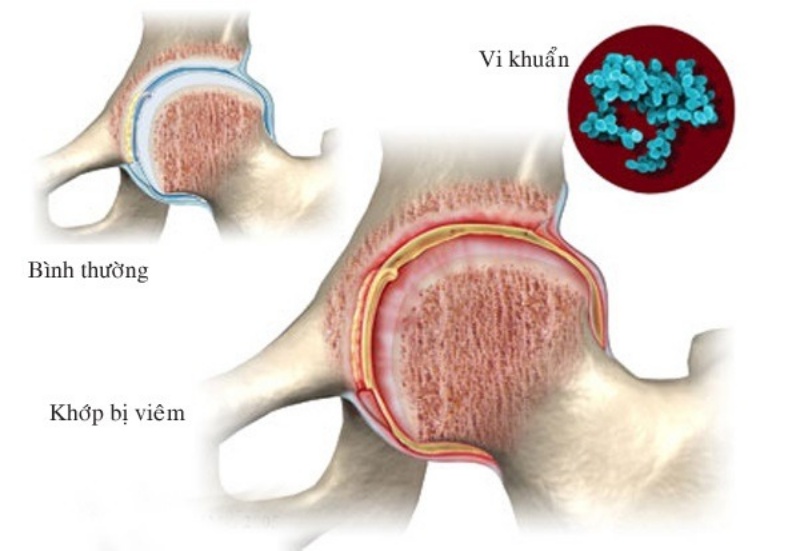 Viêm khớp nhiễm khuẩn là gì?