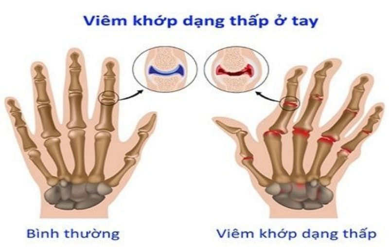 Đặc điểm bệnh khác nhau viêm khớp thông thường và viêm khớp dạng thấp