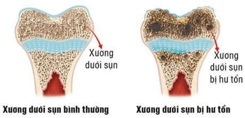 Sụn và xương dưới sụn tổn thương đồng thời