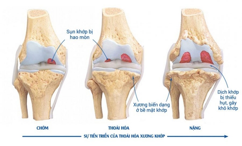 Tác động tiêu cực lên nhau đẩy nhanh thoái hóa khớp