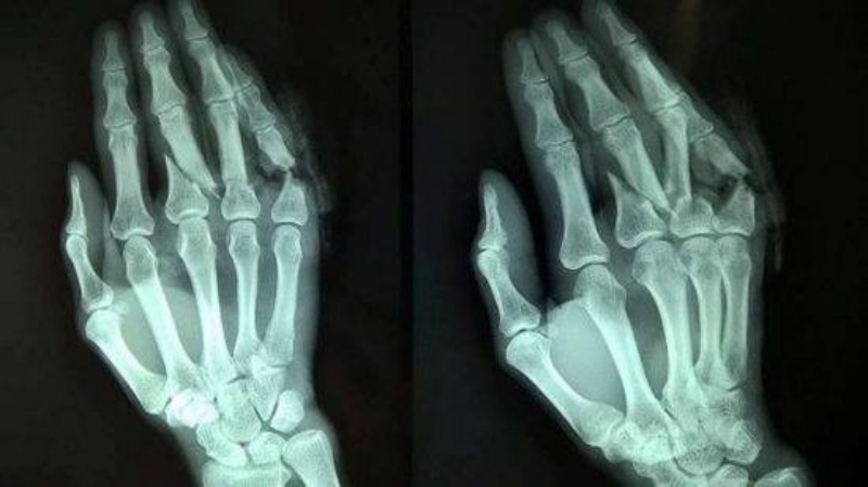 Triệu chứng gãy xương bàn tay bạn cần biết