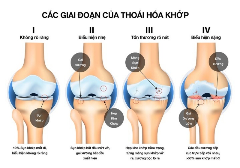 Các giai đoạn thoái hóa khớp