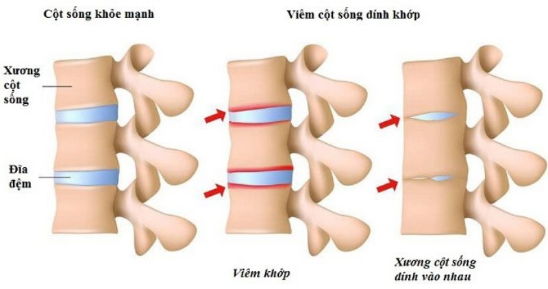 Triệu chứng viêm cột sống dính khớp