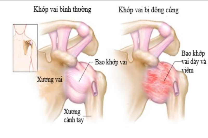 Viêm quanh khớp vai là bệnh gì?