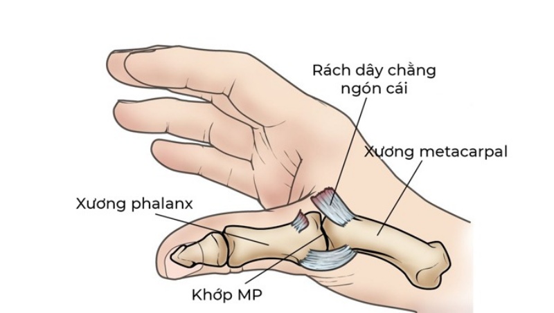 Viêm khớp ngón tay cái là gì?