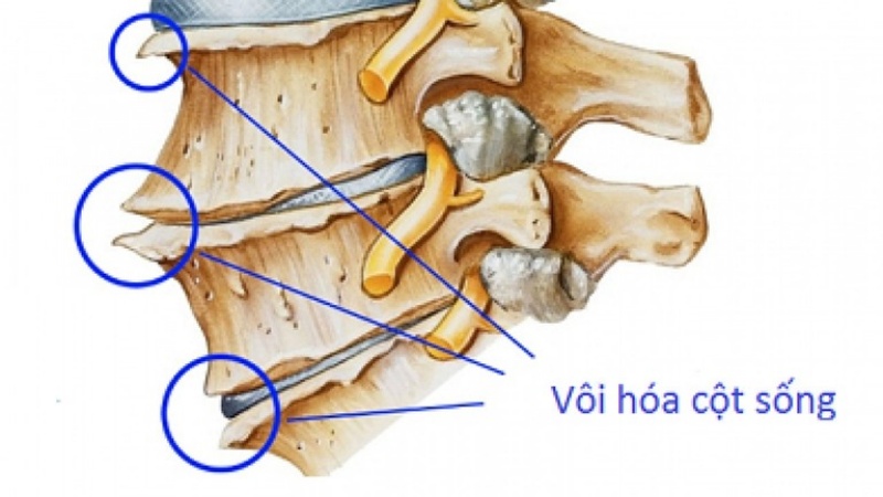 Vôi hóa hóa cột sống là gì?