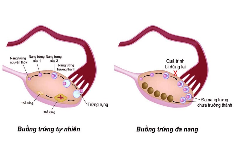 Phụ nữ mắc hội chứng đa nang cũng dễ bị rụng tóc