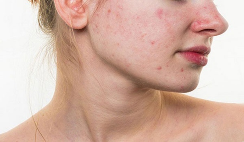 Làn da bị dị ứng đối với các loại mỹ phẩm làm trắng da cấp tốc
